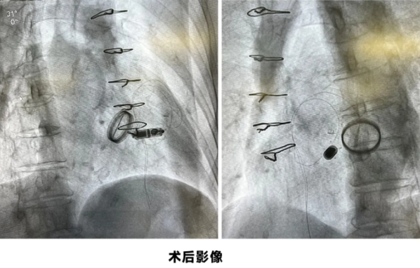 吕梁市第一人民医院心血管内科团队以无导线技术为高危老人破局“心”困境