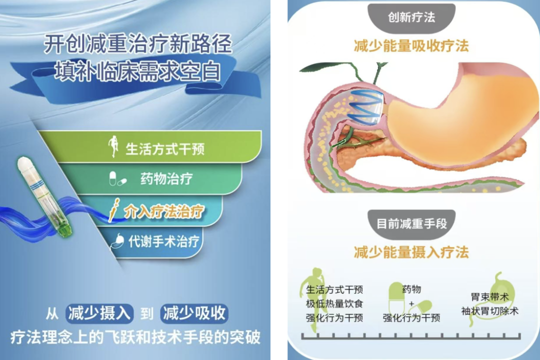 山西省汾阳医院消化内科二病区开展内镜下胃转流支架置入术，为肥胖与代谢疾病患者带来