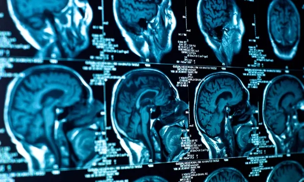 加拿大暴发神秘神经疾病：或已致150人中招9人死亡