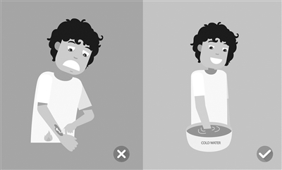 烧烫后抹牙膏、香油甚至还涂老鼠油？当心二次伤害